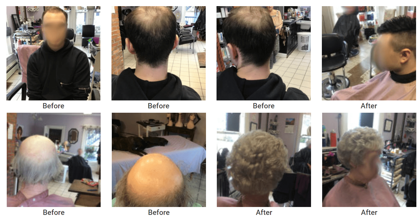 hair replacement Bolton, Massachusetts 